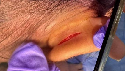 武汉一女童上高端托儿班耳朵疑被撕裂 家长:院方说监控坏了