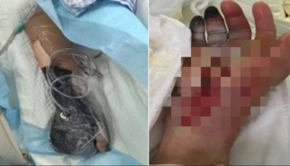 戴手套!戴手套!死亡率近100%,浙江已有人中招