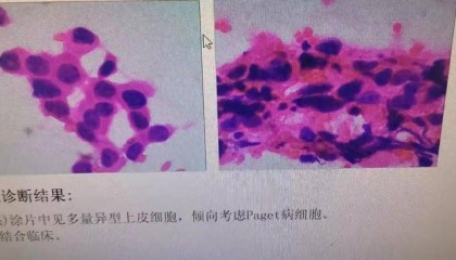 以为是湿疹,结果竟是癌!宁波女子悔惨:反复涂了一年药膏都没好!很多患者首诊都去了皮肤科